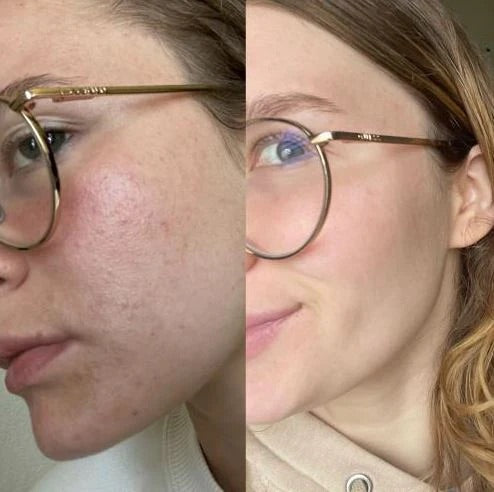 Facelift - Cuidado de la piel